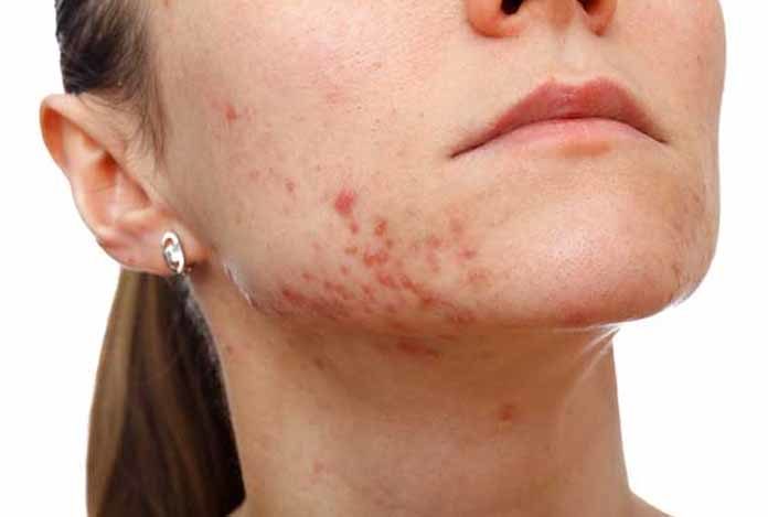 Hội chứng Bloch-Sulzberger - Hình ảnh minh họa